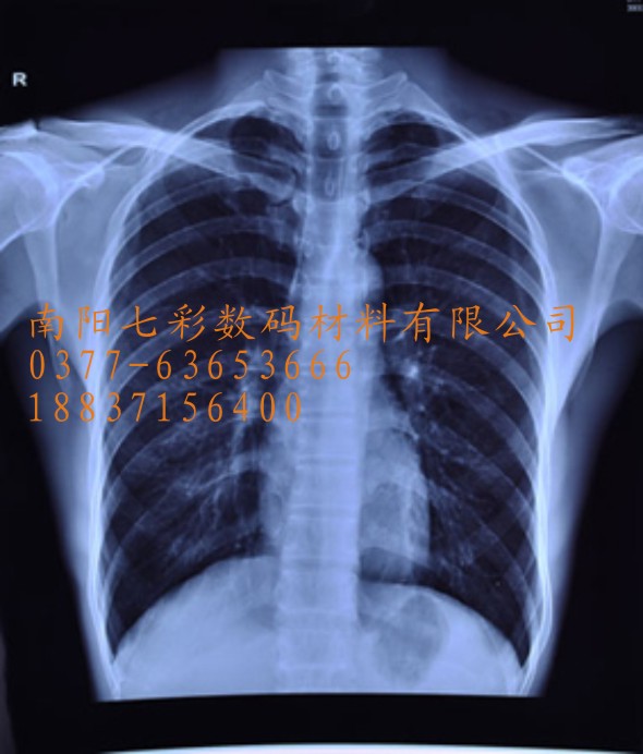 蘭州醫用激光膠片酒泉醫用藍基白基X線B超噴墨膠片