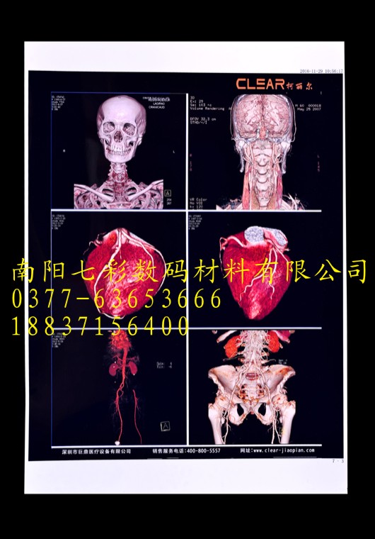 嘉峪關醫用噴墨膠片蘭州醫用藍基白基B超CT激光X線膠片